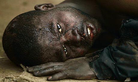 A burnt and injured man lies in front of a shack during clashes  east of Johannesburg, South Africa