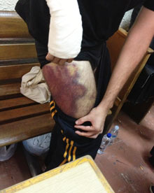 injuries fromth e Greek police